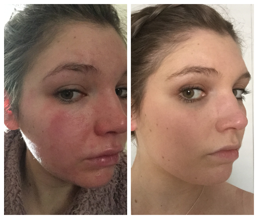 A close-up picture of a young's woman's face with skin irritation.