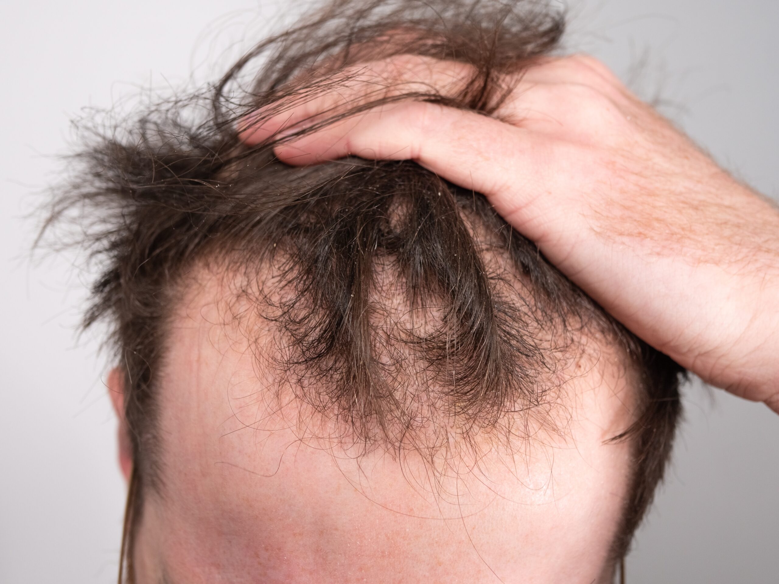 Testosterone Hair Loss