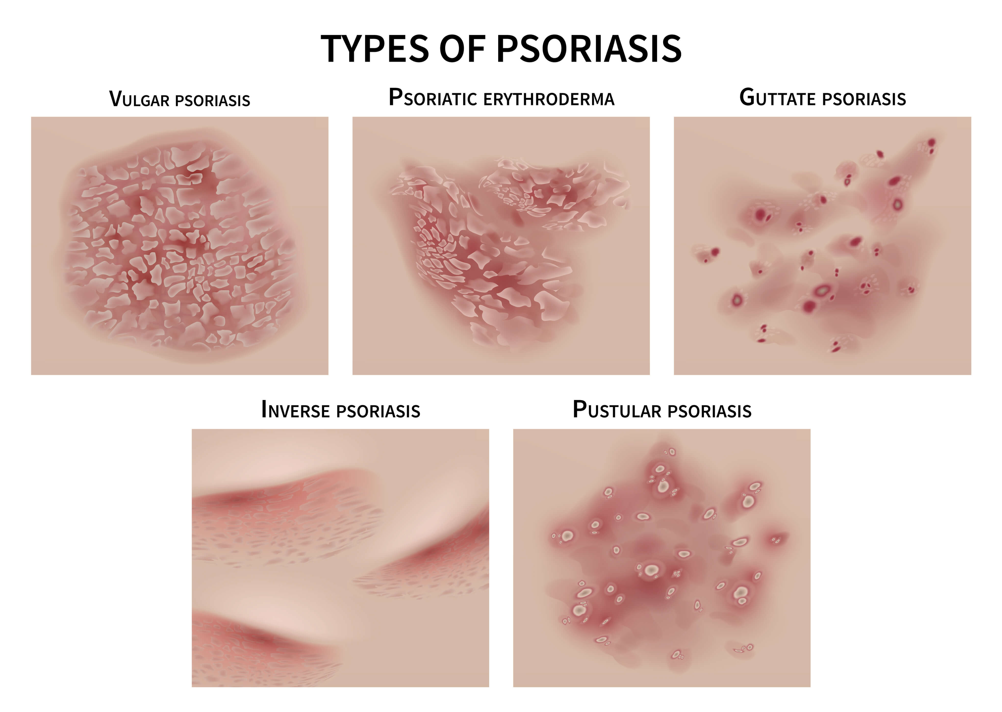 Psoriasis - What’s that itch?